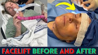 Shocking Facelift Before During amp After Neck Lift  facelift surgery before and after [upl. by Novanod]