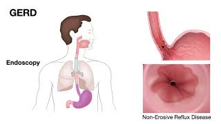 ECE2bPathology of EsophagusGERDErosive esophagitis [upl. by Zeuqirdor180]