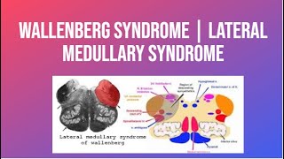 Wallenberg Syndrome  Lateral Medullary Syndrome  PhysiotherapyKnowledge [upl. by Banky593]