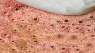 Most Satisfying Pimples and Blackheads Removal Videos  10 [upl. by Notnirb]