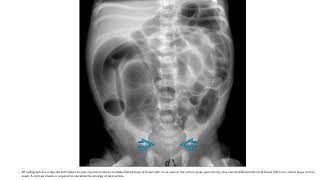 Hirschsprung Disease Imaging [upl. by Panta]