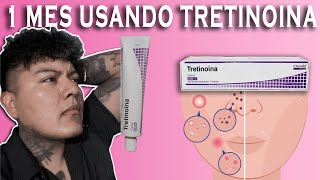 1 MES USANDO TRETINOINA ¡ Me quito las marcas de acné [upl. by Nairda]