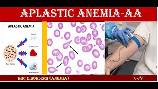 Lecture 161 Aplastic Anemia  AP [upl. by Tabina]