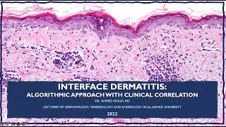 Interface Dermatitis Made easy [upl. by Aeslahc]