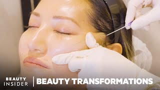 How Nonsurgical FaceLifts Work With PDO Threads  Beauty Transformations  Insider Beauty [upl. by Suirauqram]