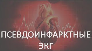 Псевдоинфарктные ЭКГ Имитация элевации ST Псевдокоронарный Т quotФейковаяquot гиперкалиемия Часть 2 [upl. by Nazario]