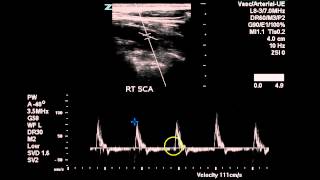 Bilateral Subclavian Artery Duplex  Case Study [upl. by Letsirk]