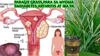 PARAGIS GRASSPARA SA MYOMADIABETESARTHRITIS AT IBA PA [upl. by Niriam621]