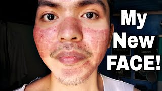 My Fractional CO2 Laser Treatment Experience TAGALOG [upl. by Ahtekal]