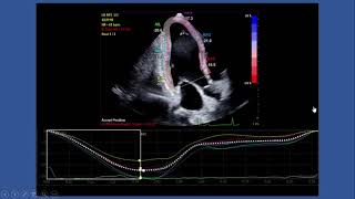 Strain Echocardiography by speckle tracking and tissue Doppler Part Itechnique [upl. by Mcconaghy207]