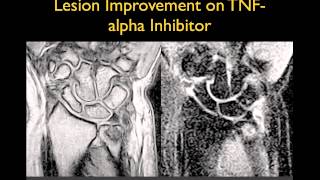 MRI in the Evaluation of Rheumatoid Arthritis [upl. by Anpas]