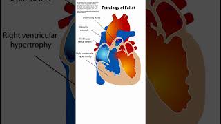 Tetralogy of Fallot [upl. by Melleta339]