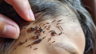 How to Get Rid of Lice Effective Lice Treatment in 3 Steps [upl. by Ferreby]