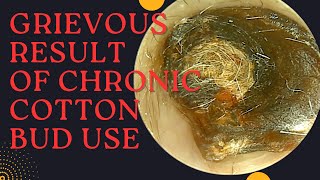 GRIEVOUS Result Of Chronic Cotton Bud Use Very Satisfying Earwax Removal [upl. by Charissa835]