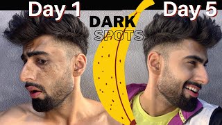 REMOVE Dark Spots in 5 DAYS  Mridul Madhok [upl. by Aiuqram]