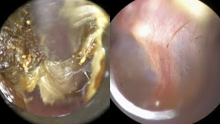 134  Extreme Ear Wax Blockage Removal From Tender Ear using WAXscope®️ [upl. by Subir]