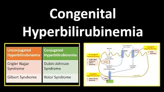 Congenital Hyperbilirubinemia  Crigler Najjar SyndromeGilbert SyndromeDubinJohnson Syndrome [upl. by Emelun768]