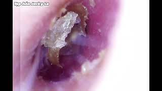 Ear Wax Removal 125 Narrow ear canal but lots of earwax  Ear Cleaning ASMR [upl. by Katti636]