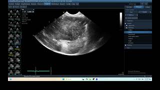 IQ 279 LIVER ULTRASOUND HEPATOMA ECHOPAC ANALYSIS ECHOCARDIOGRAPHY [upl. by Annaillil]