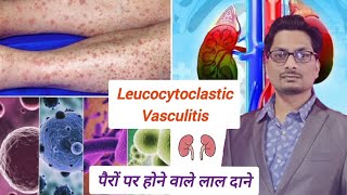 पैरों पर होने वाले लाल दाने  Leucocytoclastic Vasculitis Sudden Red Spots on Leg Palpable Purpura [upl. by Frayda]