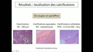 Calcifications thyroïdiennes  facteur prédictifs de malignité [upl. by Nugesulo]