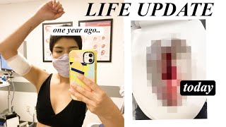 I finally got my period after a YEAR my nexplanon experience  a vlog [upl. by Lleuqar]