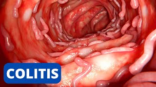 La COLITIS explicada síntomas tipos consecuencias tratamiento prevención [upl. by Karrah526]