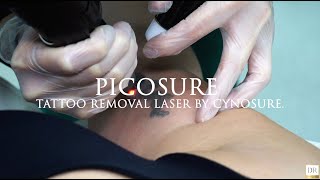 Picosure laser tattoo removal Derma revive [upl. by Ankney]