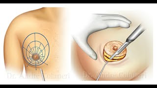 Ginecomastia Pseudoginecomastia Lipomastia Dr André Colaneri explica detalhes [upl. by Kal898]