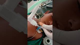 5 point auscultation for confirming position of endotracheal tube in trachea anaesthesia shorts [upl. by Raven]