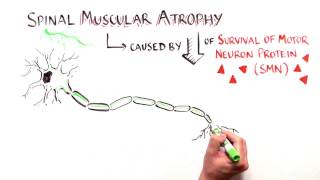 Cut and Paste Treating Spinal Muscular Atrophy with Nusinersen [upl. by Oiramel]