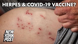 Herpes infection possibly linked to COVID19 vaccine  New York Post [upl. by Engud670]