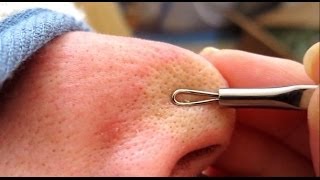 3A of 4 Removing Blackheads amp Whiteheads Using A Comedone Extractor Tool HD [upl. by Elfstan]