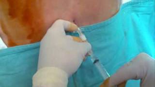 CSE combined spinal epidural anaesthesia needle to needle tecnique [upl. by Enaej]