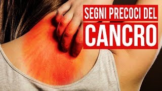 10 Segni Precoci Del Cancro Che La Maggior Parte Delle Persone Ignora [upl. by Elgar]