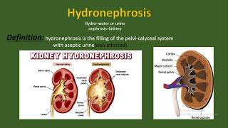 Hydronephrosis Definition causes and etiology pathology types diagnosis treatment [upl. by Orin]