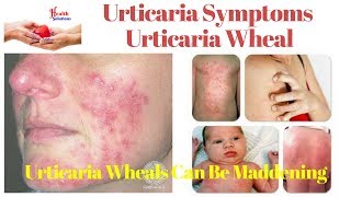 Urticaria Symptoms  Urticaria Wheal  Urticaria Wheals Can Be Maddening 😛 [upl. by Suanne]