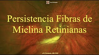 Persistencia de Fibras de Mielina Retinianas [upl. by Wollis]