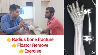 fixator remove  radius bobe fracture Exercise in hand wrist fracture [upl. by Hayidan]