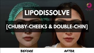 MESOTHERAPY Before and After  Face Slimming AMAN 2018  Ovela Clinic JAKARTA [upl. by Ainud]