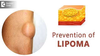 Prevent Lipomas From Occurring  Fatty Lump  Fatty Tumor  Dr Sahebgowda Shetty  Doctors Circle [upl. by Nylyram75]