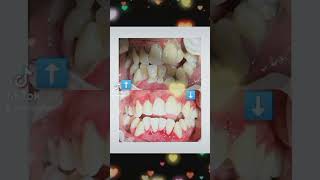 Scaling with polishing highlights everyone foryou dentalhealth [upl. by Alexine]