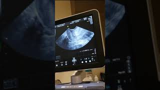 5 weeks 5 days Pregnancy Ultrasound  TTC 1  Our Angel Baby Heartbeat [upl. by Anwahs963]