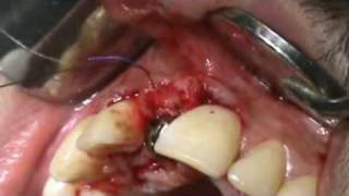 3i Implant placement in the aesthetic zoneafter EASY GRAFT socket preservation [upl. by Eric]