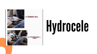 Hydrocele case presentation  Surgery posting [upl. by Odranreb]