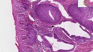 Cervix Squamous metaplasia amp carcinoma in situ [upl. by Joane]