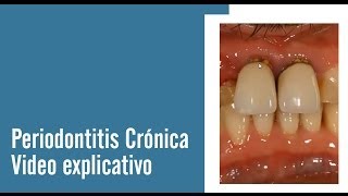 Periodontitis Crónica  Juan Salgado  Enfermedades Periodontales  Video explicativo [upl. by Ellecrag]