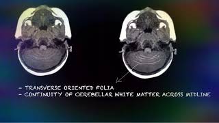 “Exploring Rhombencephalosynapsis The Mystery of Fused Brain Structures” COMPLETE OVERVIEW [upl. by Otrebor]