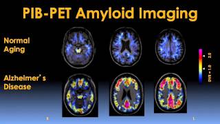 Early Detection and Prevention of Alzheimers Disease Video  Brigham and Womens Hospital [upl. by Jewelle277]