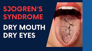 Sjogrens Syndrome  Dry Eyes Dry Mouth HELPED by Dr Suh Chiropractic [upl. by Avehstab]